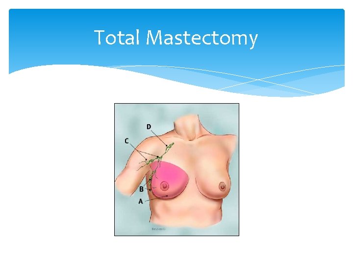 Total Mastectomy 