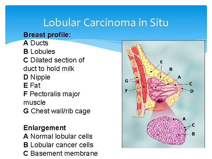 Lobular Carcinoma in Situ Breast profile: A Ducts B Lobules C Dilated section of