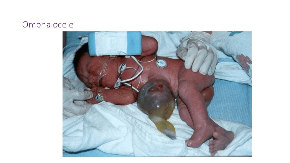 Omphalocele 