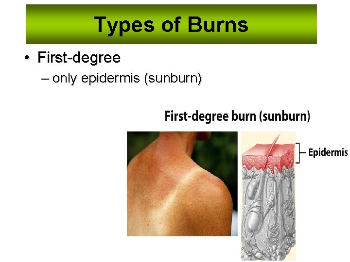 Types of Burns • First-degree – only epidermis (sunburn) Slide 53 