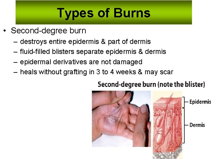 Types of Burns • Second-degree burn – – destroys entire epidermis & part of