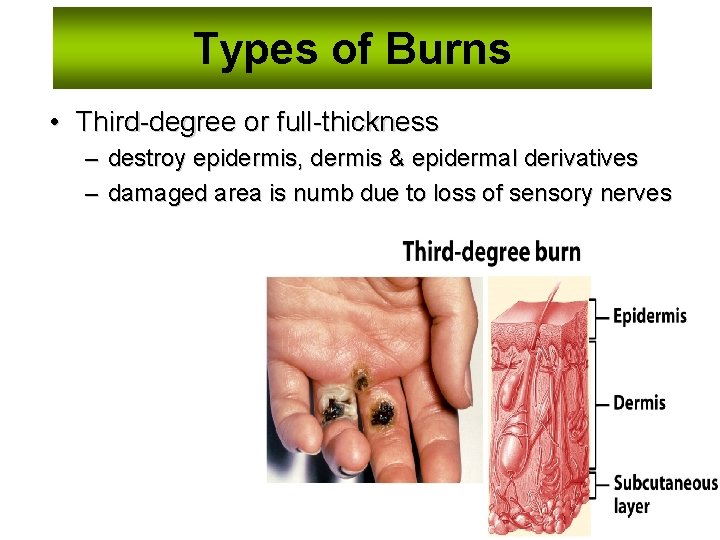 Types of Burns • Third-degree or full-thickness – destroy epidermis, dermis & epidermal derivatives