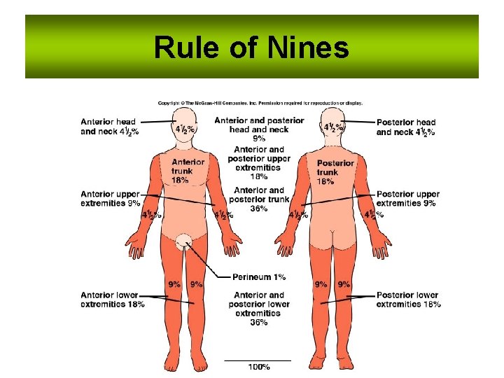 Rule of Nines 