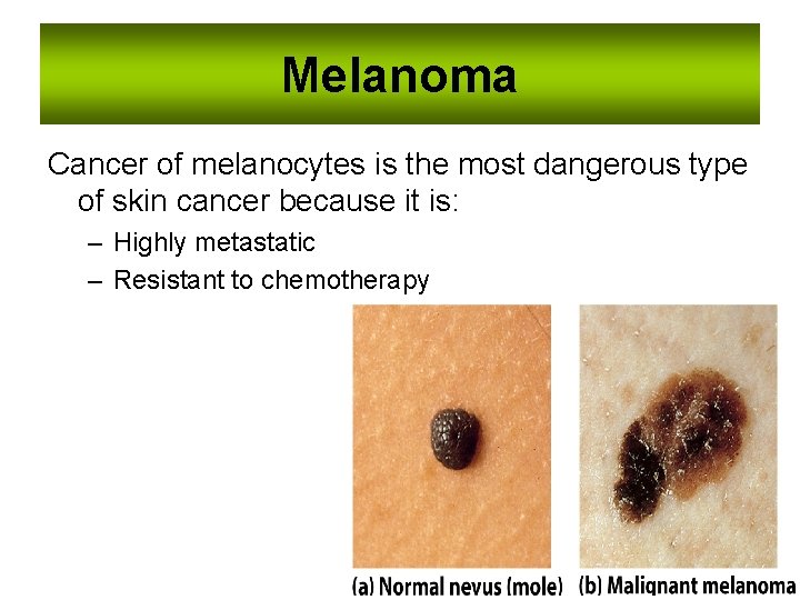 Melanoma Cancer of melanocytes is the most dangerous type of skin cancer because it