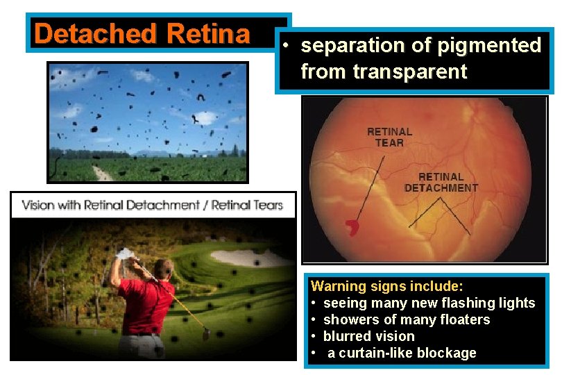 Detached Retina • separation of pigmented from transparent Warning signs include: • seeing many