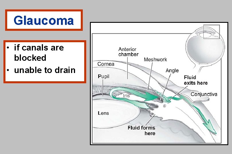 Glaucoma • if canals are blocked • unable to drain 