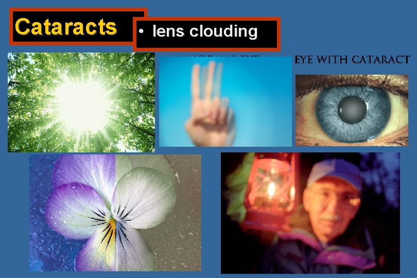 Cataracts • lens clouding 