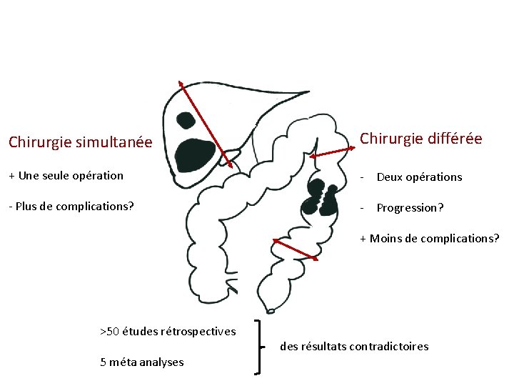 Chirurgie simultanée Chirurgie différée + Une seule opération - Deux opérations - Plus de