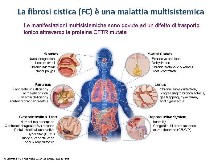 La fibrosi cistica (FC) è una malattia multisistemica Le manifestazioni multisistemiche sono dovute ad