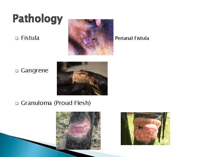 Pathology q Fistula q Gangrene q Granuloma (Proud Flesh) Perianal Fistula 