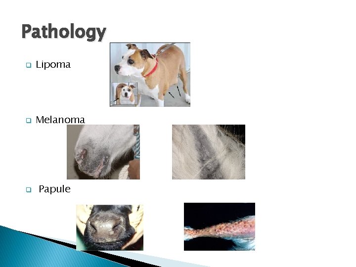 Pathology q Lipoma q Melanoma q Papule 