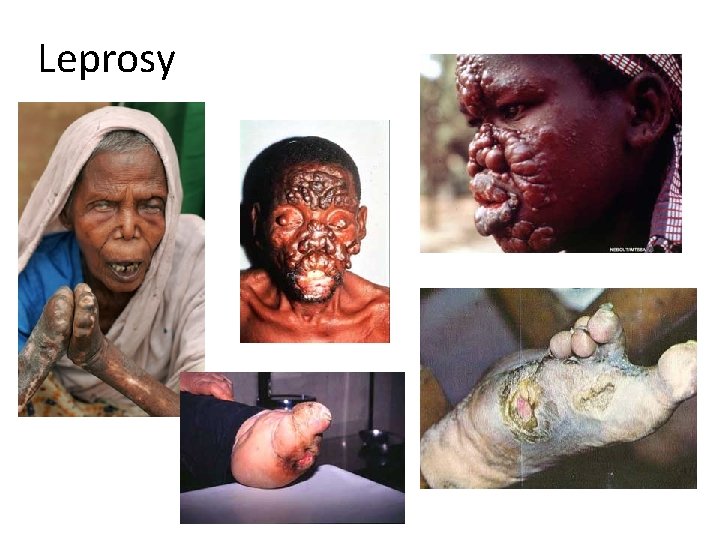 Leprosy 