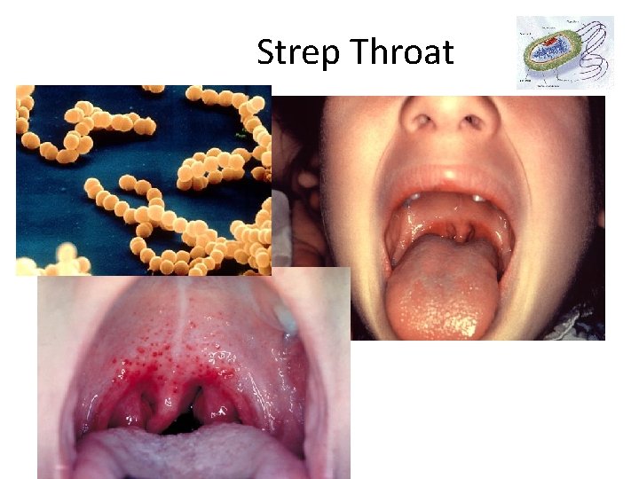 Strep Throat 