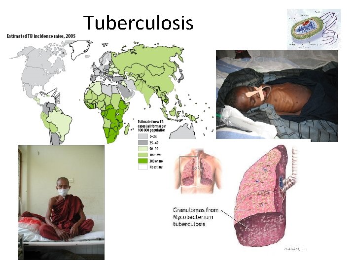 Tuberculosis 