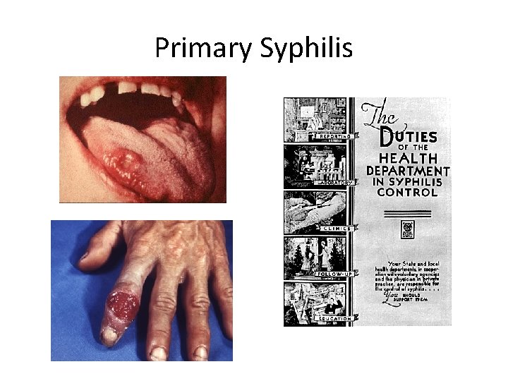 Primary Syphilis 