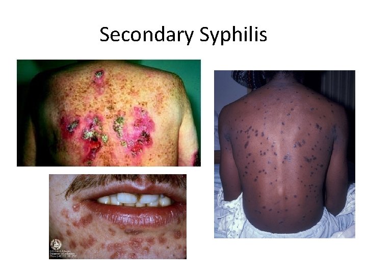 Secondary Syphilis 