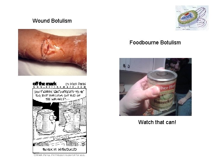 Wound Botulism Foodbourne Botulism Watch that can! 