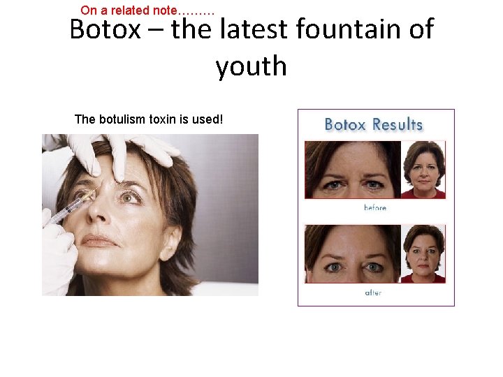 On a related note……… Botox – the latest fountain of youth The botulism toxin