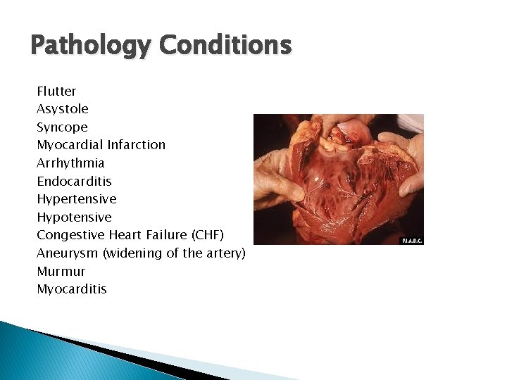 Pathology Conditions Flutter Asystole Syncope Myocardial Infarction Arrhythmia Endocarditis Hypertensive Hypotensive Congestive Heart Failure