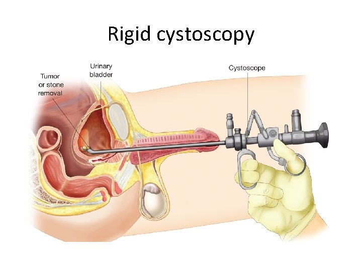 Rigid cystoscopy 