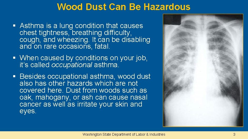 Wood Dust Can Be Hazardous § Asthma is a lung condition that causes chest