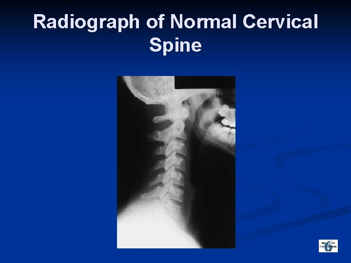 Radiograph of Normal Cervical Spine 