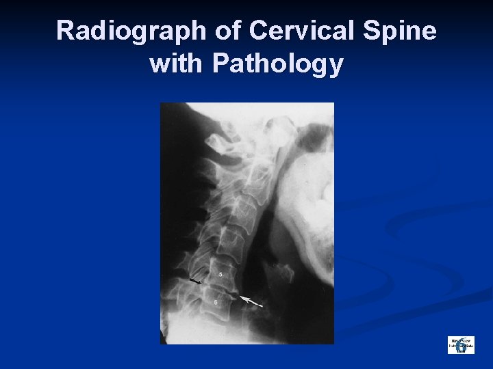 Radiograph of Cervical Spine with Pathology 