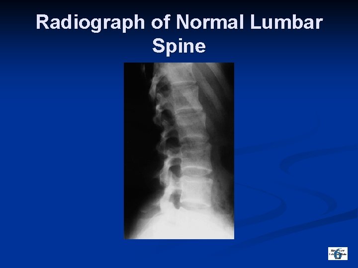 Radiograph of Normal Lumbar Spine 