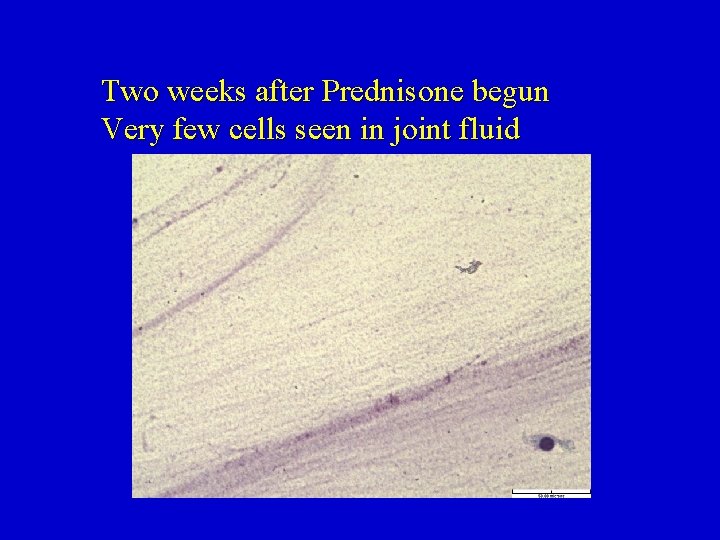 Two weeks after Prednisone begun Very few cells seen in joint fluid 