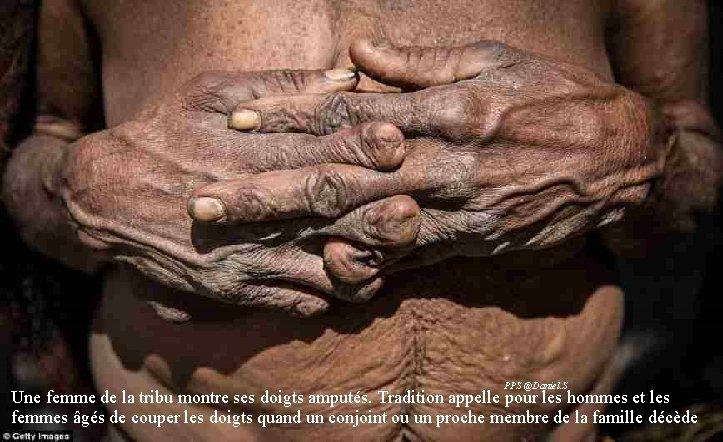 PPS @Daniel. S Une femme de la tribu montre ses doigts amputés. Tradition appelle