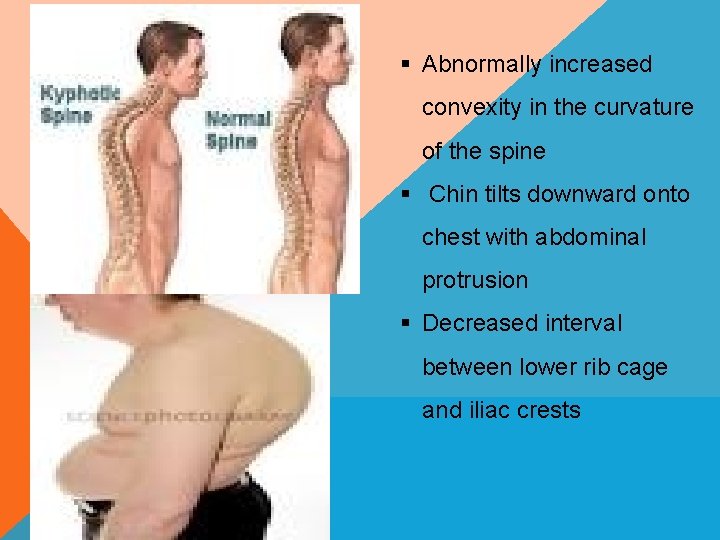 § Abnormally increased convexity in the curvature of the spine § Chin tilts downward