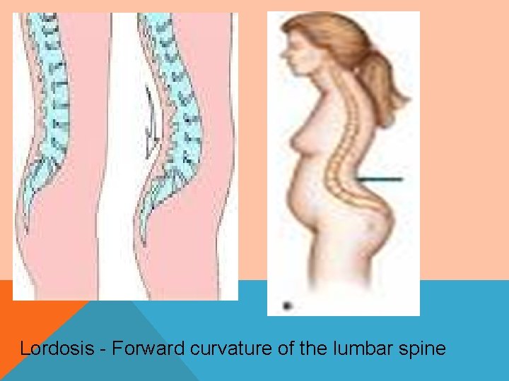 Lordosis - Forward curvature of the lumbar spine 