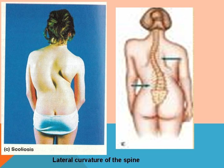 Lateral curvature of the spine 