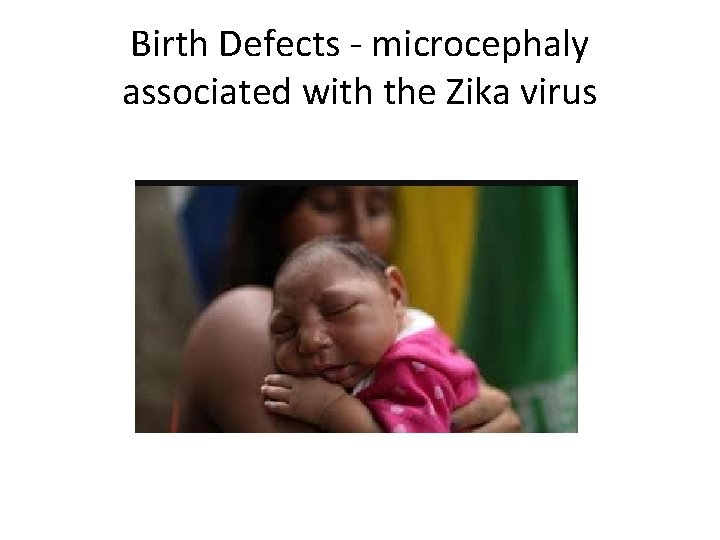 Birth Defects - microcephaly associated with the Zika virus 