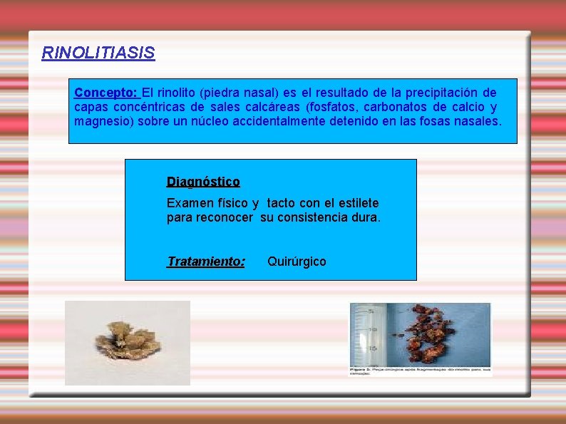 RINOLITIASIS Concepto: El rinolito (piedra nasal) es el resultado de la precipitación de capas