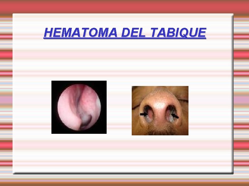 HEMATOMA DEL TABIQUE 