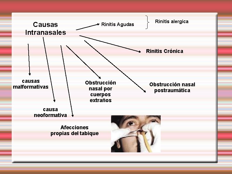 Causas Intranasales Rinitis Agudas Rinitis alergica Rinitis Crónica causas malformativas Obstrucción nasal por cuerpos