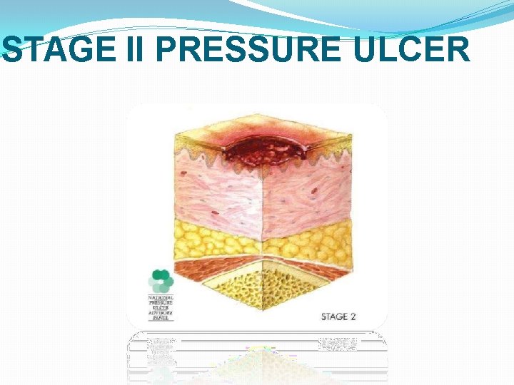 STAGE II PRESSURE ULCER 