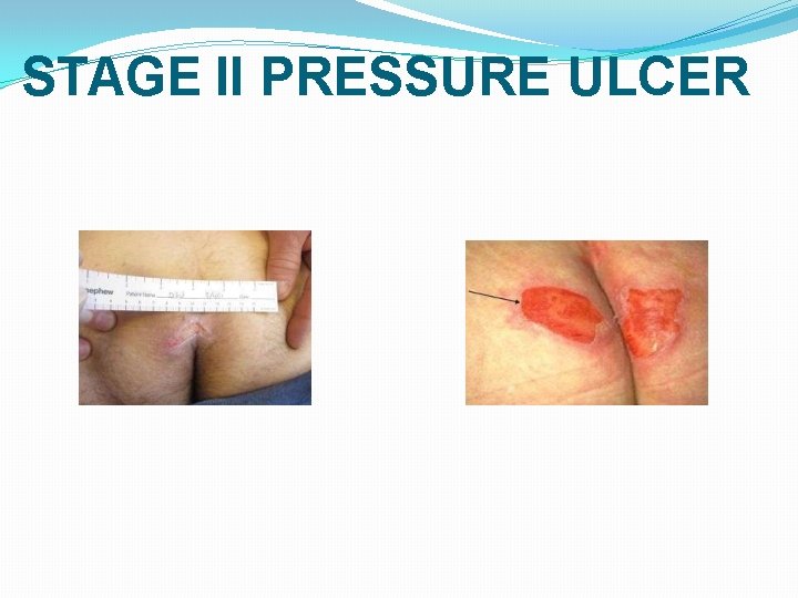 STAGE II PRESSURE ULCER 