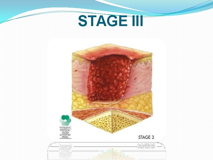 STAGE III 