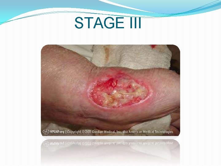 STAGE III 