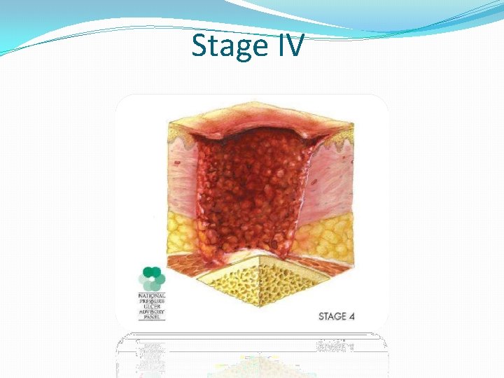 Stage IV 