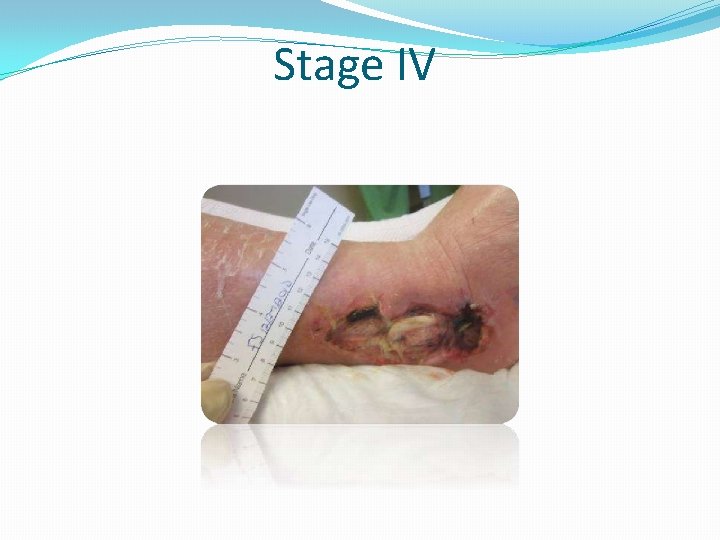 Stage IV 