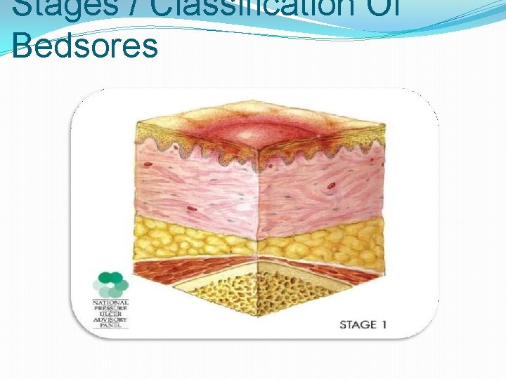 Stages / Classification Of Bedsores 