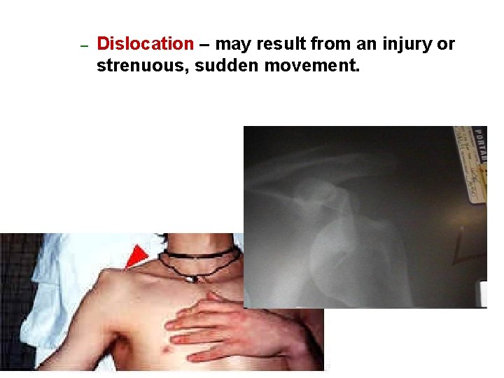 – Dislocation – may result from an injury or strenuous, sudden movement. 