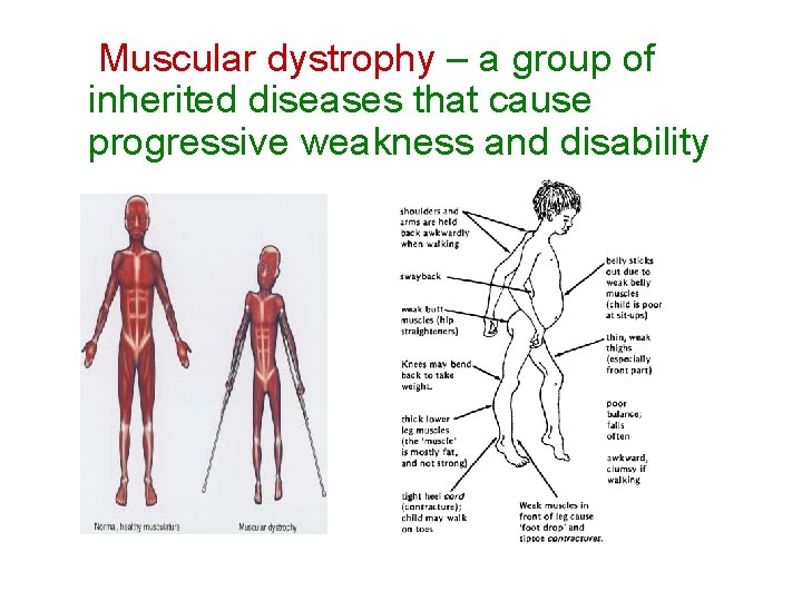 Muscular dystrophy – a group of inherited diseases that cause progressive weakness and disability