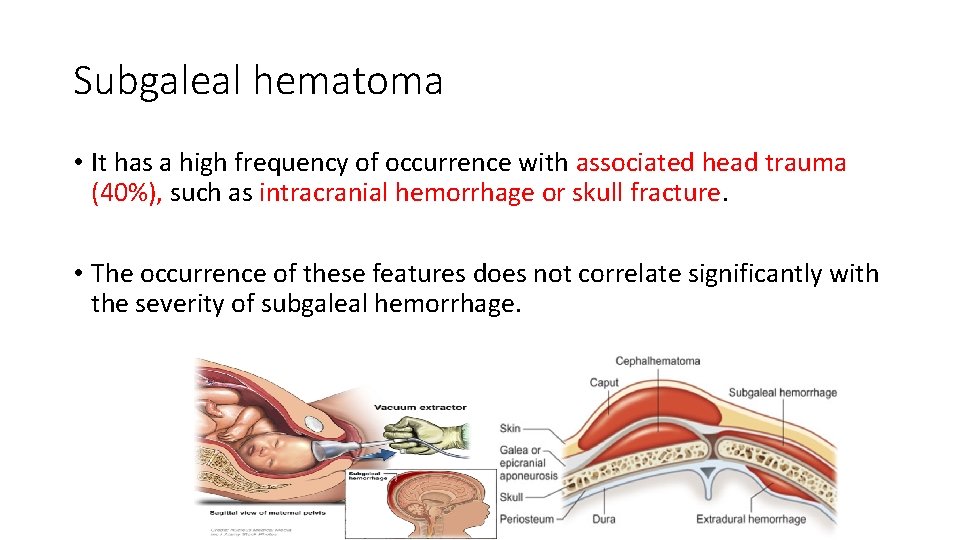 Subgaleal hematoma • It has a high frequency of occurrence with associated head trauma