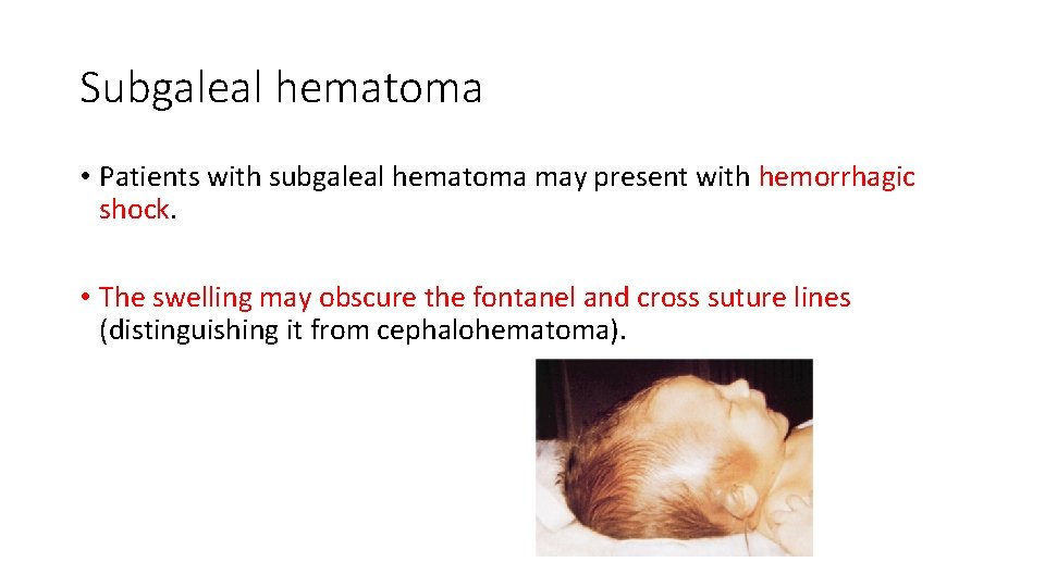 Subgaleal hematoma • Patients with subgaleal hematoma may present with hemorrhagic shock. • The