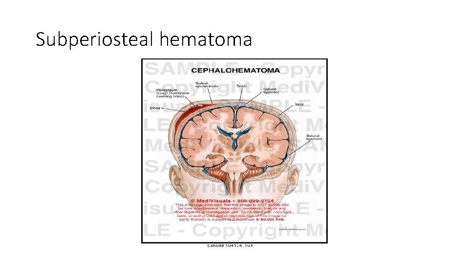 Subperiosteal hematoma 