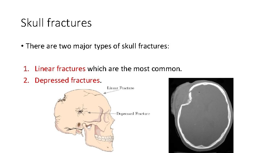 Skull fractures • There are two major types of skull fractures: 1. Linear fractures